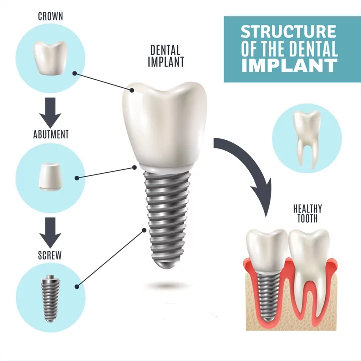 Structure of Dental Implants
